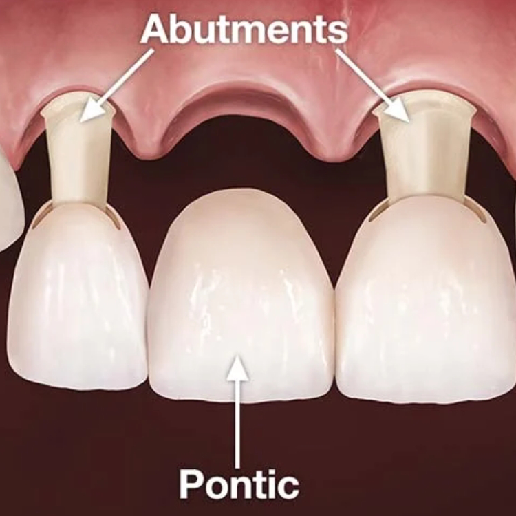 Dental bridges