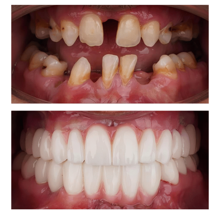 all-on-4-dental-implants-full-mouth-in-vietnam