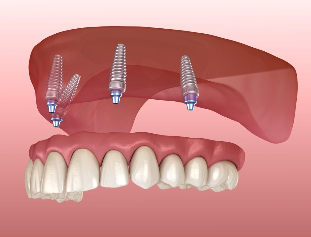 all on 4 dental implants