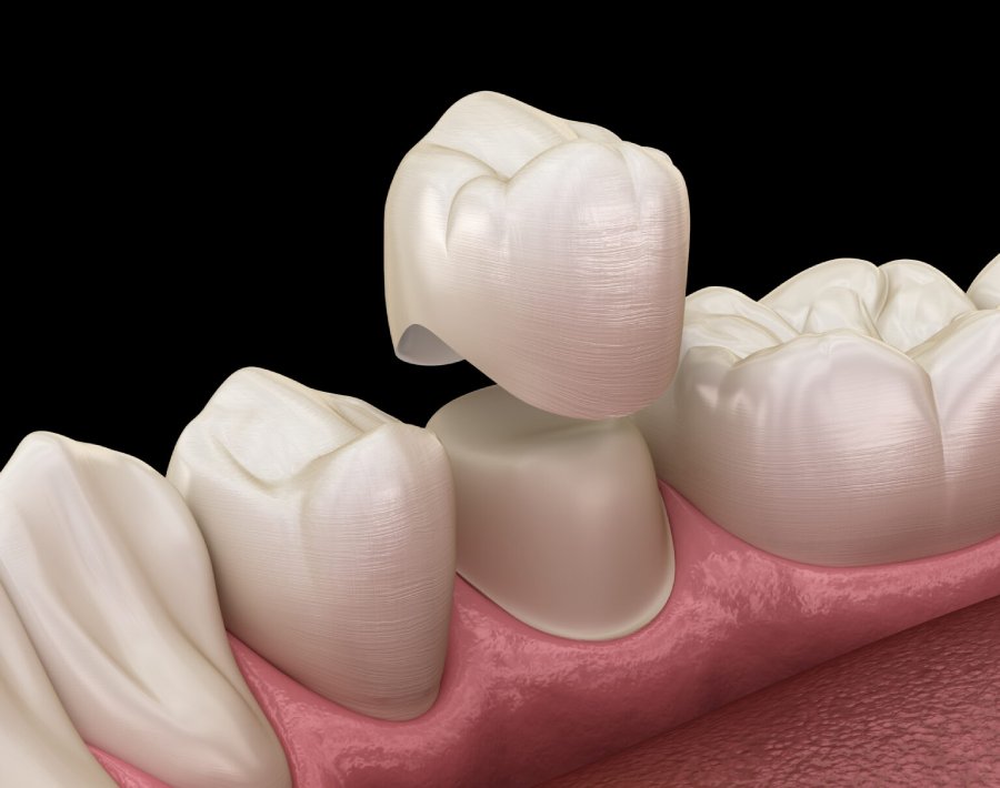 Dental crowns