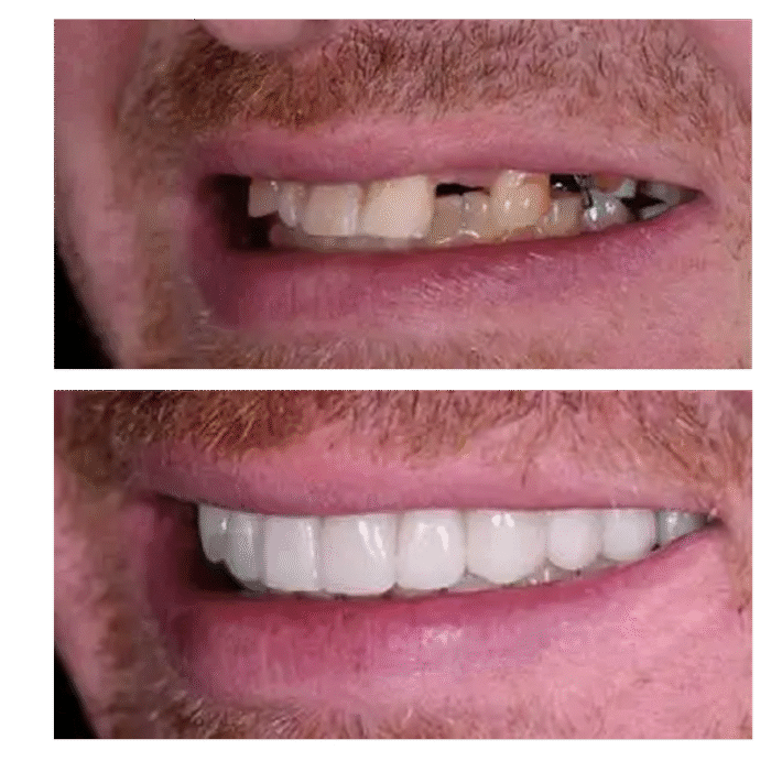 dental-implants-vietnam