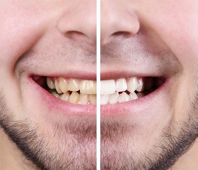 laser teeth whitening efficient
