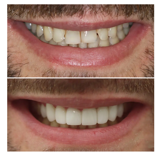 porcelain veneers smile-makeover