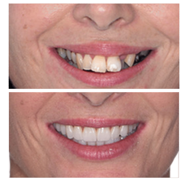 all on 4 dental implants