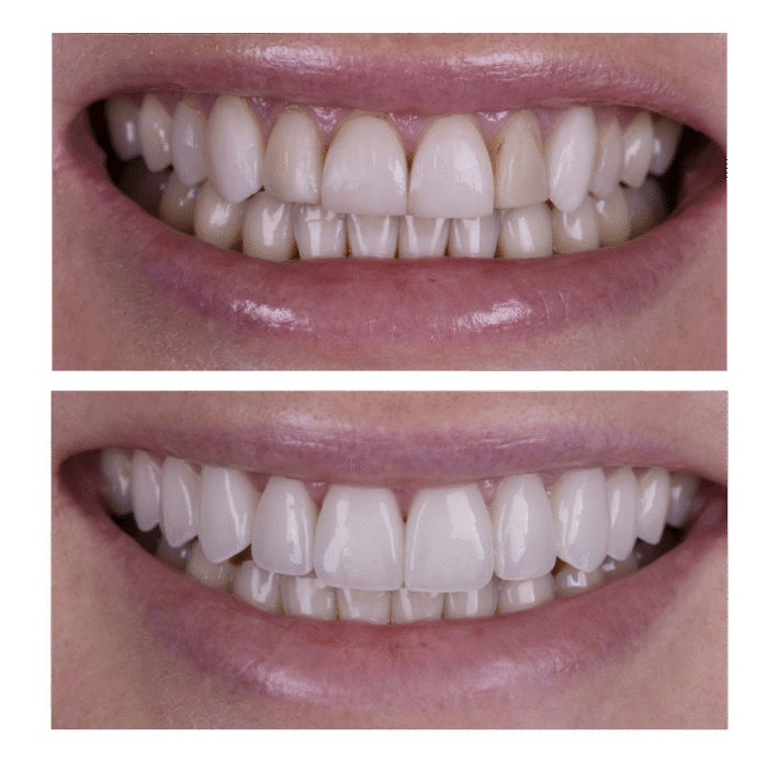 smile-makeover-vietnam---veneers
