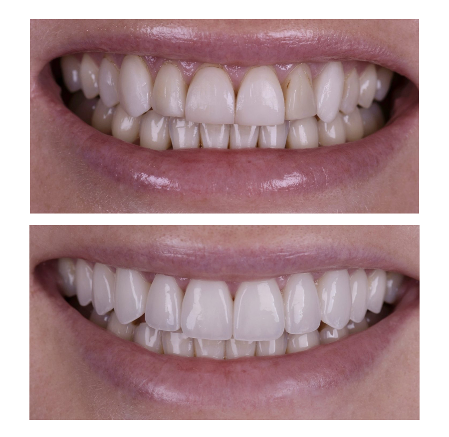 smile-makeover-vietnam---veneers