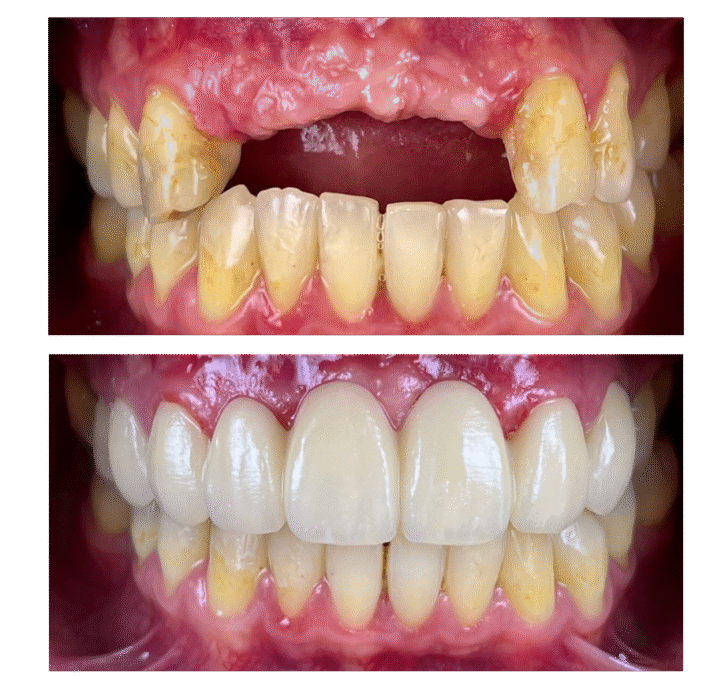 23 Zirconia Crowns in Vietnam Finally Gave Me a Smile I Love