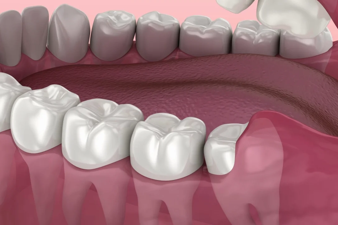 wisdom tooth removal